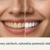 Porównanie wybielania zębów przed i po: żółte zęby po lewej, białe po prawej. Uśmiech pełen blasku.