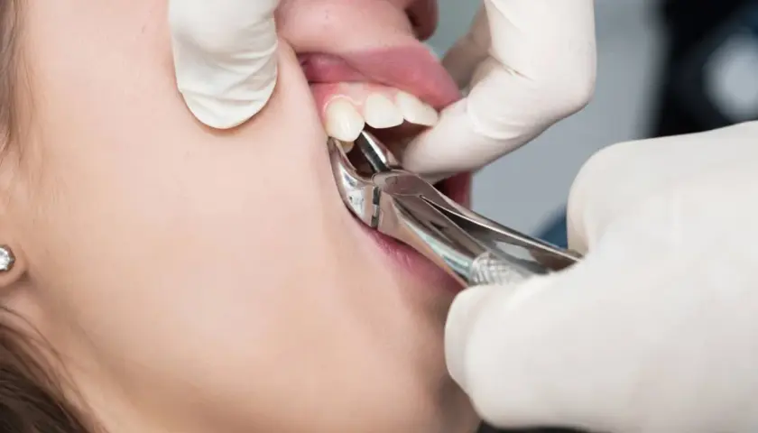 Dentysta usuwa ząb kleszczami. Zastanawiasz się, ile kosztuje wyrwanie zęba prywatnie?