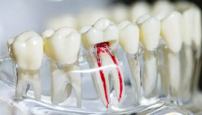 Model zęba z widocznym uszkodzonym kanałem korzeniowym, ilustrujący potrzebę leczenia endodontycznego.
