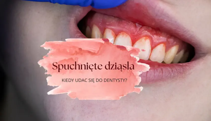 Opuchnięte dziąsło? Natychmiastowa ulga i kiedy do dentysty