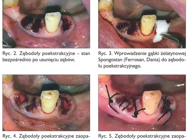 Krwawienie po wyrwaniu zęba: ile trwa i kiedy szukać pomocy?