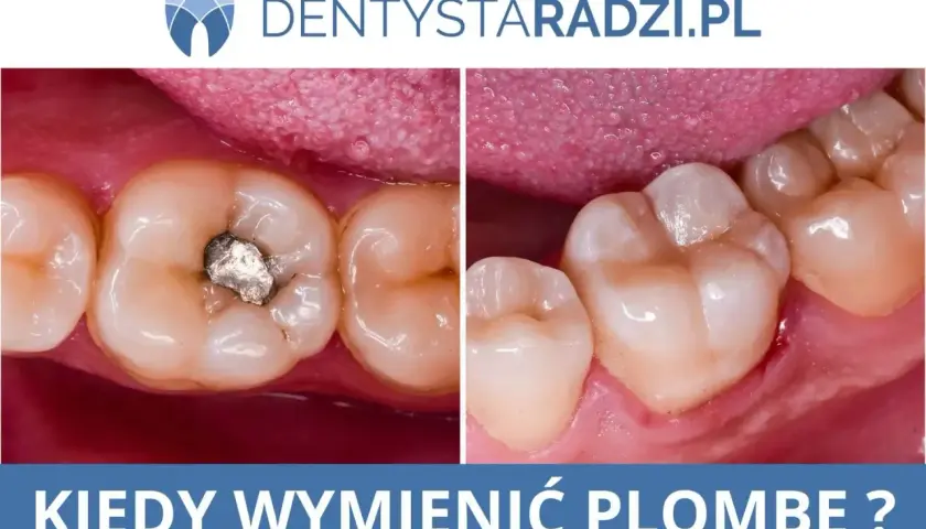 Porównanie zęba przed i po wymianie wypełnienia. Zdjęcie pokazuje stary, metalowy wypełnienie zęba obok nowego, estetycznego wypełnienia.