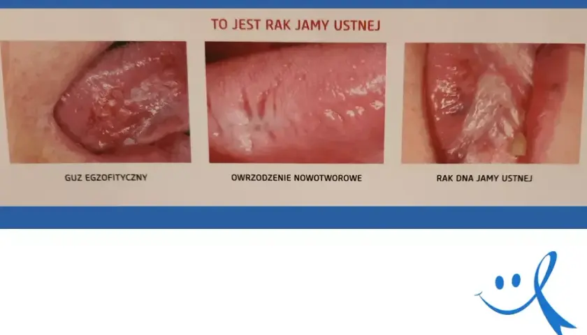 Rak jamy ustnej: wczesne objawy, które musisz znać (do 70 znaków)