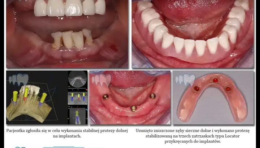 Proteza na belce stabilizowana na implantach. Widok przed i po leczeniu, planowanie implantacji.