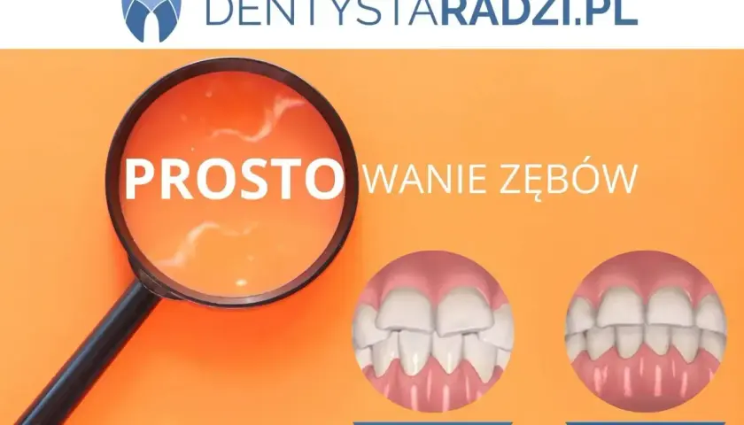 Proste licówki na krzywe zęby. Porównanie uśmiechu przed i po zabiegu.