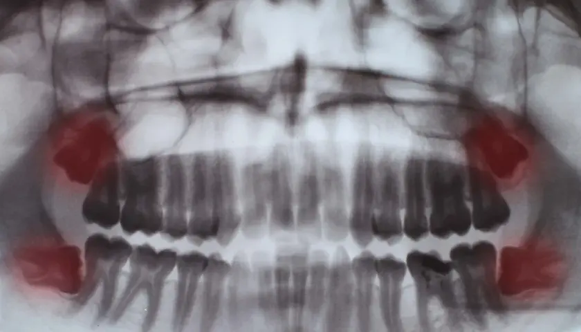 Kiedy rosną zęby mądrości? Objawy, ból i kiedy iść do dentysty