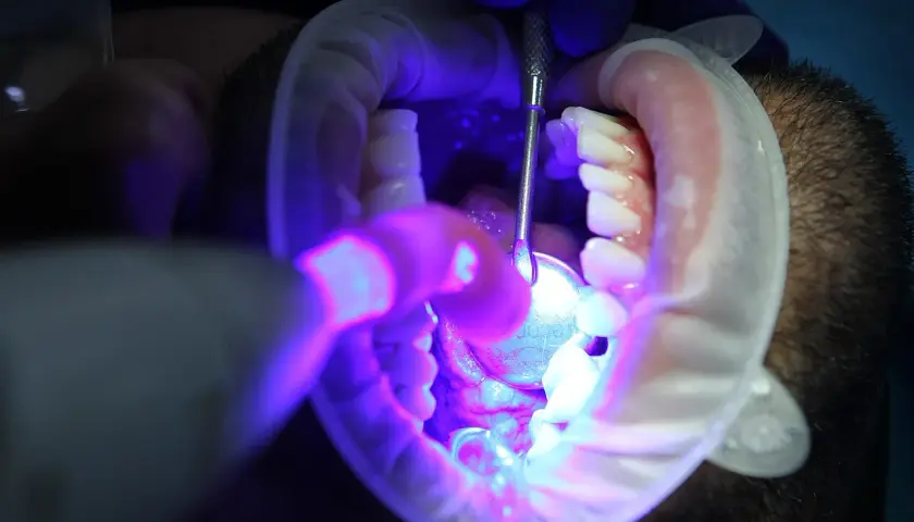 Zabieg stomatologiczny: jak wybielić martwy ząb. Dentysta używa lampy UV i narzędzi do wybielania zęba.