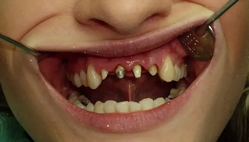 Usta z widocznymi zębami, niektóre wymagają leczenia. Widać fragmenty narzędzi dentystycznych. Planowana jest korona porcelanowa.