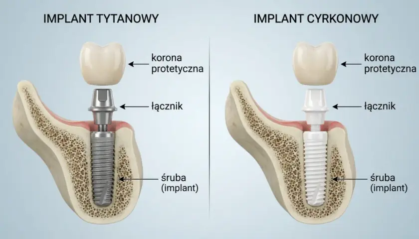 Porównanie rodzajów implantów zębowych: tytanowego i cyrkonowego, z widocznymi elementami: śrubą, łącznikiem i koroną protetyczną.