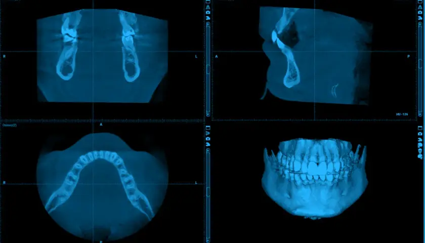 Tomografia zębów cena: szczegółowy obraz szczęki i żuchwy w trzech projekcjach, w tym widok 3D.