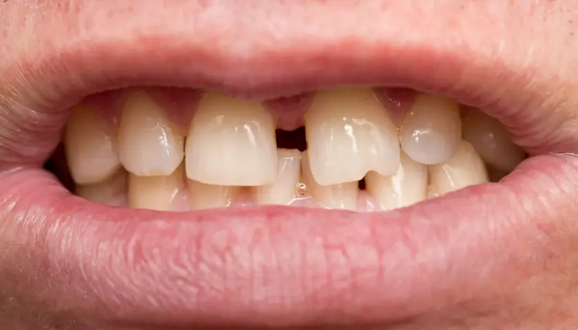 Widoczne usta z zębami, w tym charakterystyczna przerwa między przednimi zębami, czyli diastema.