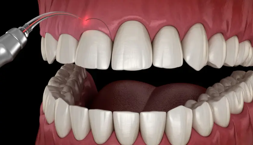 Zabieg gingiwektomii laserem: precyzyjne modelowanie dziąseł dla pięknego uśmiechu.