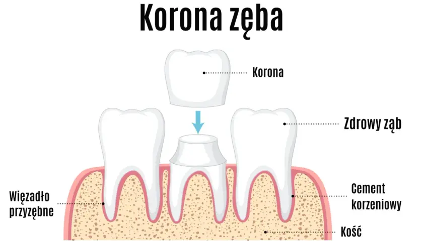 Ilustracja pokazuje proces zakładania korony tymczasowej na ząb. Widoczne są zdrowe zęby, cement korzeniowy i kość.
