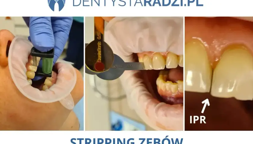 Zabieg stripping zębów, czyli IPR, polega na delikatnym modelowaniu przestrzeni międzyzębowych.