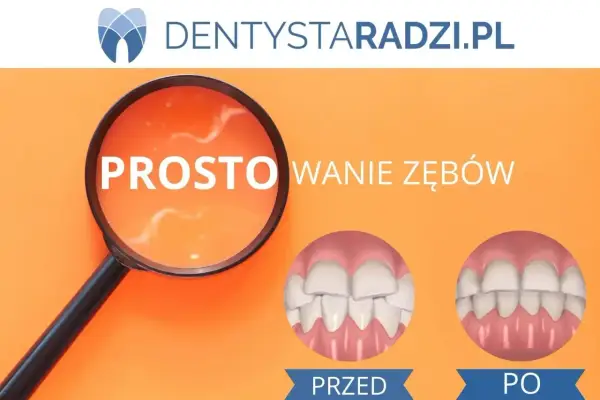 Proste licówki na krzywe zęby. Porównanie uśmiechu przed i po zabiegu.